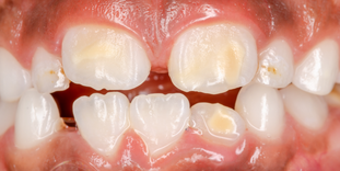 Kreidezähne bei Milchzähne