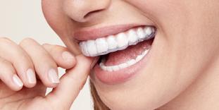 Bruxism grinding guard from bestsmile
