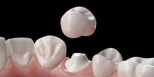 Stripping dentaire pour les couronnes