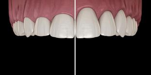 Gummy Smile Korrektur Vorher Nachher