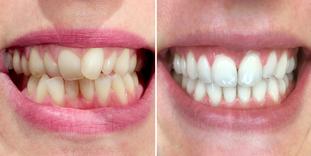 Chevauchement dentaire avant/après