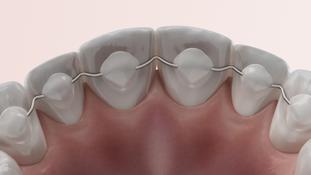 Filo retainer dopo l'apparecchio