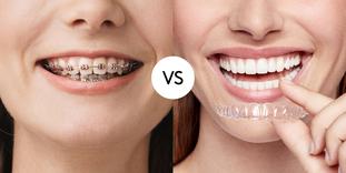 Gartenhag vs. Aligner Zahnspange