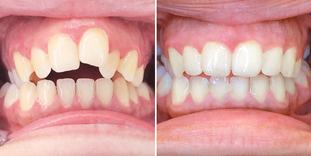 Offener Biss Vorher Nachher