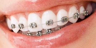 Metal brackets