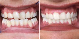 Denti storti prima e dopo