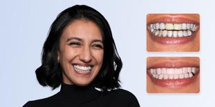 Facettes dentaires à l'etranger vs. en Suisse