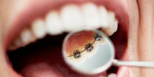 Lingual dental braces