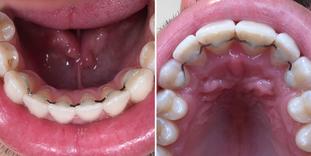 Wire retainer upper and lower jaw