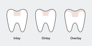 Inlay, Onlay or Overlay