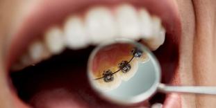 Lingual braces for adults