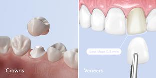 Crowns vs Veneers