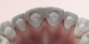 Draht-Retainer nach Aligner Behandlung