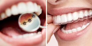 Confronto tra apparecchio linguale e allineatori trasparenti
