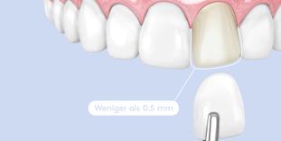 Zähne schleifen bei Veneers