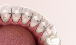 Fil de contention Retainer