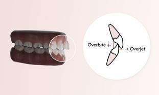 supraclusion et overjet
