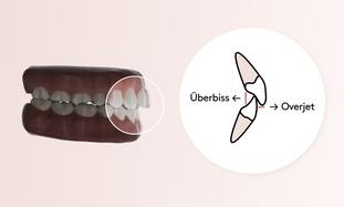 Überbiss und Overjet