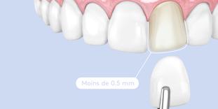 Limer les dents pour la pose de facettes dentaires