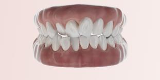 Stripping dentaire et chevauchement dentaire