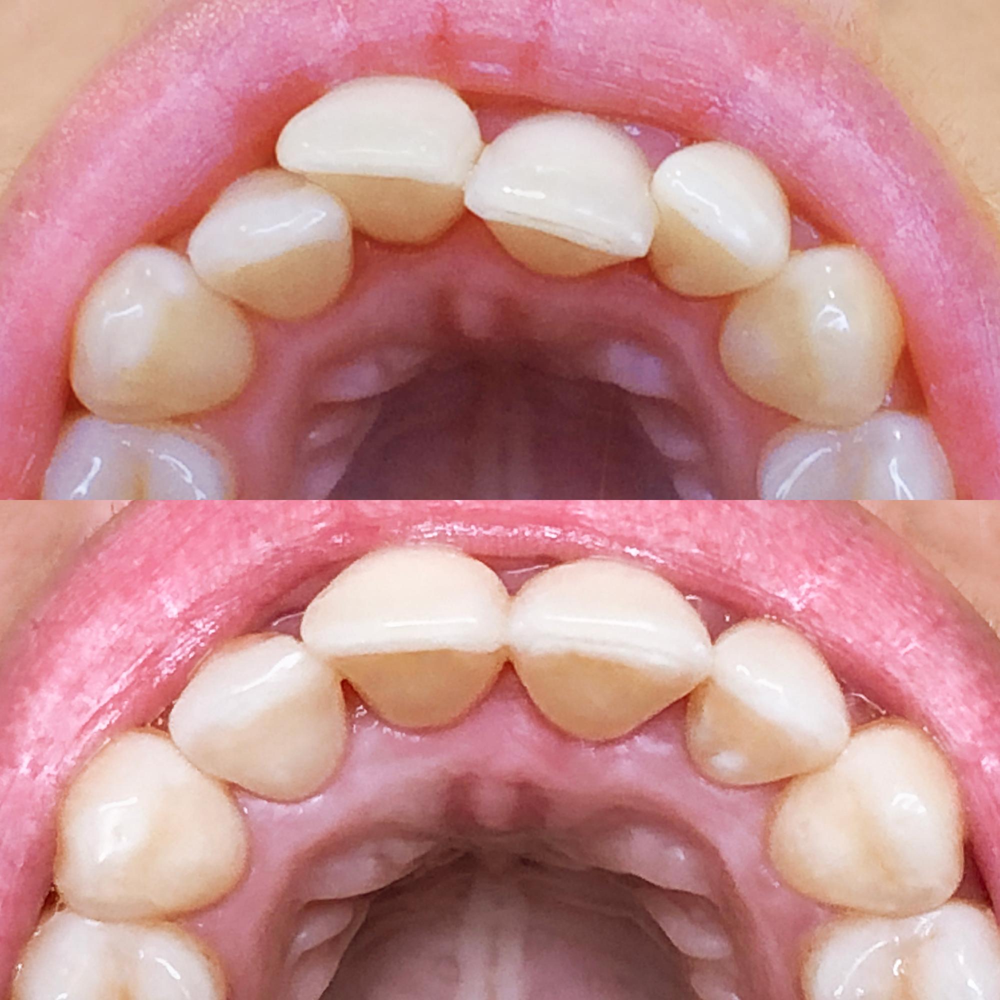 aligner treatment before/after comparison 7.5 1