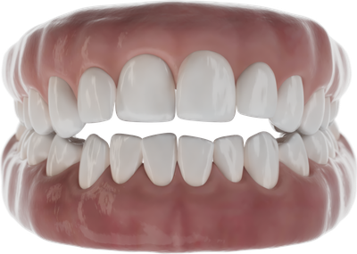 Close open bite with aligners