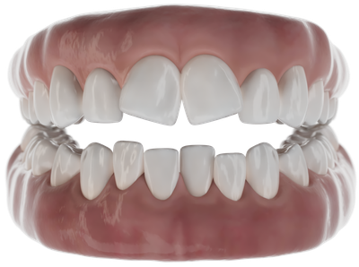 Straighten crooked teeth with aligners